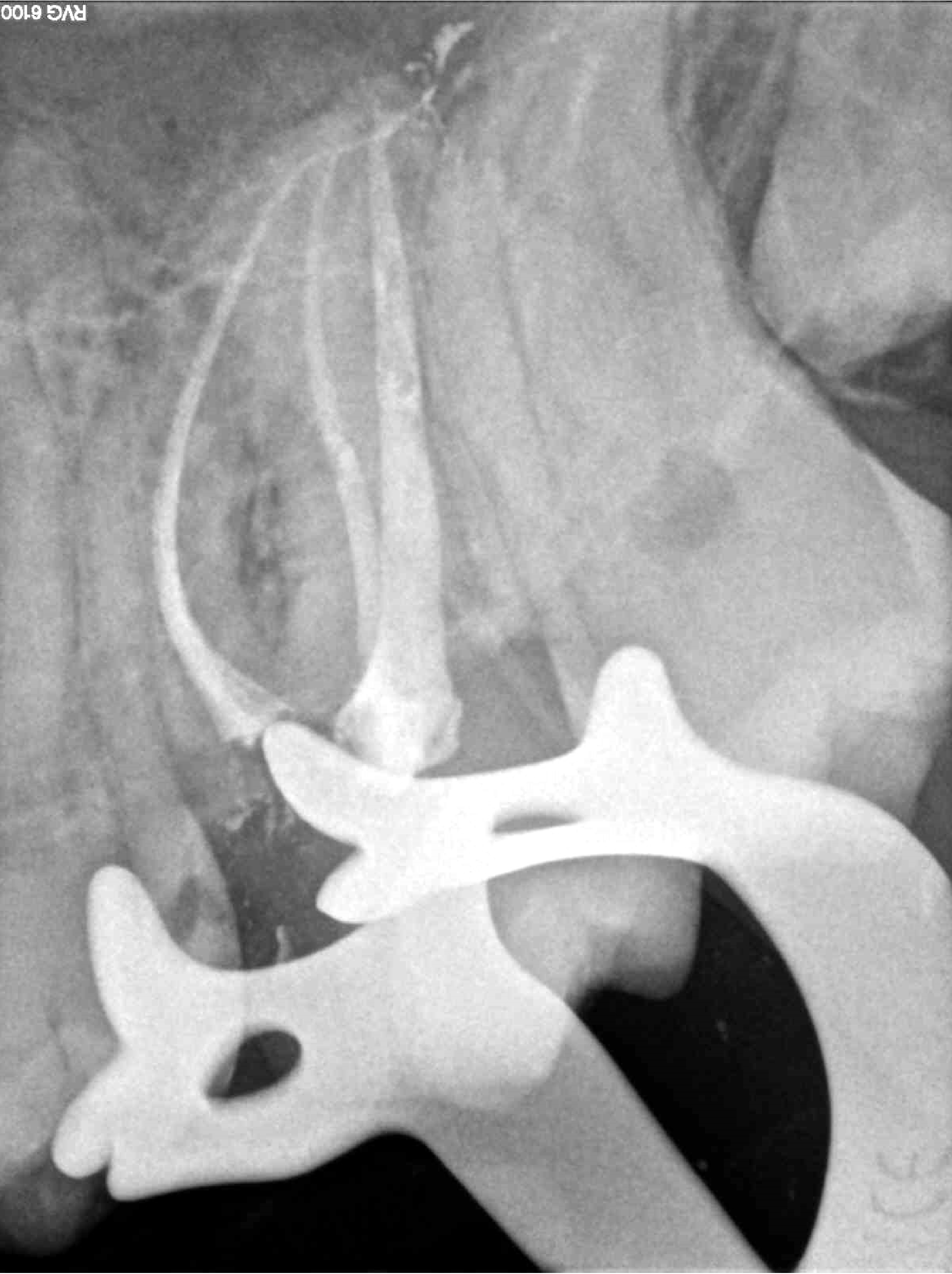 2.7 Pulpitis irreversible
